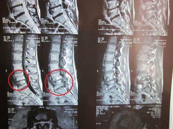 Emakakaela osteokondroosi diagnoosimine