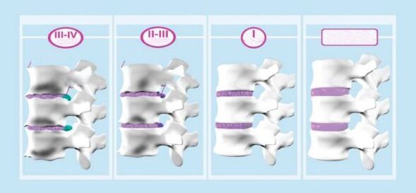 Emakakaela osteokondroosi etapid
