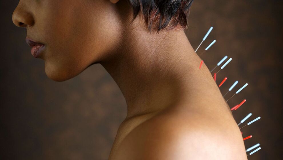 Emakakaela osteokondroosiga nõelravi