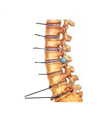 Kuidas osteokondroos areneb
