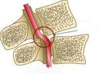 Vail Arteri sündroom