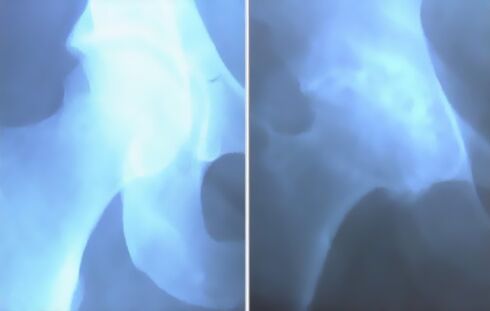 Põlveliigese artroosi saast