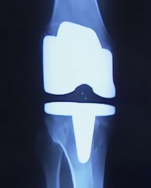 X -RAY PILDI PILDI PROTSEERIMINE KOHTA PROSTEES PROTSEES