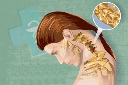 Osteokondroosi refleksümptomid